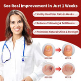 Toenail Fungus Treatment Extra Strength, Nail Fungus Treatment with Undecylenic Acid for Toenail & Fingernails, Antifungal Nail Repair for Athletes Foot, Ingrown, Thick, Broken, Damaged Nail, 30ml