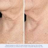 Obagi ELASTIderm Neck & Décolleté Lifting Concentrate with Patented Bi-Mineral Contour Complex, Retinoid & Alpha-Arbutin Clinically Proven to Reduce Fine Lines & Wrinkles – 2 oz